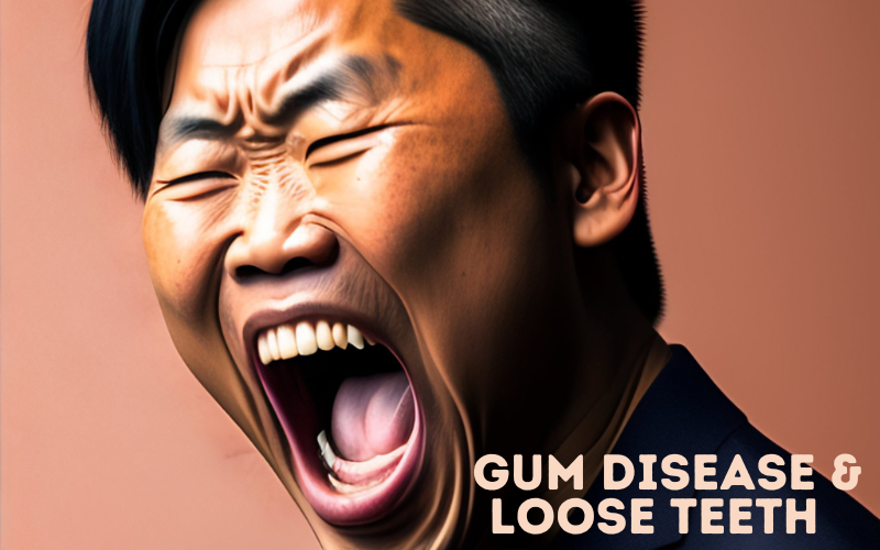Gum Disease and Loose Teeth 
